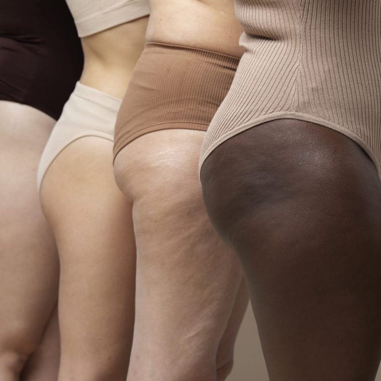Lipedema الوذمة الشحمية
